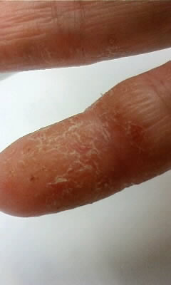 手の小指にできた汗疱が破れ乾燥している状態