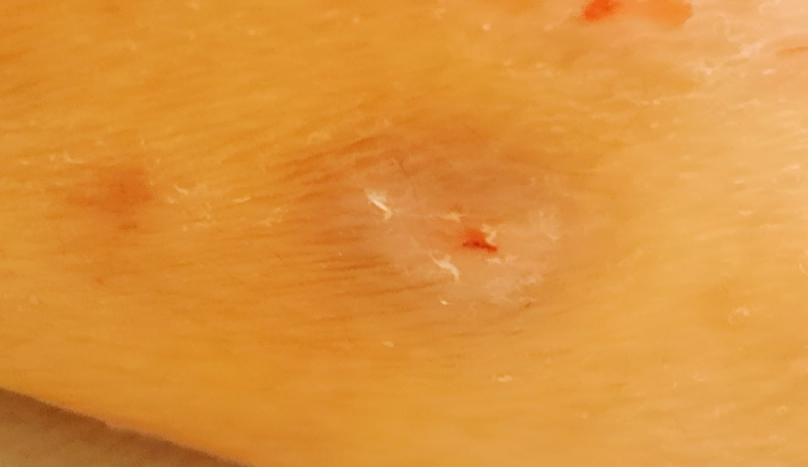 結節性痒疹の痕　患部周囲の黒ずみ